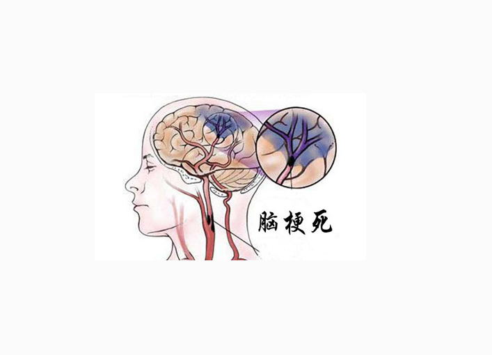 脑梗塞吃三七粉有用吗