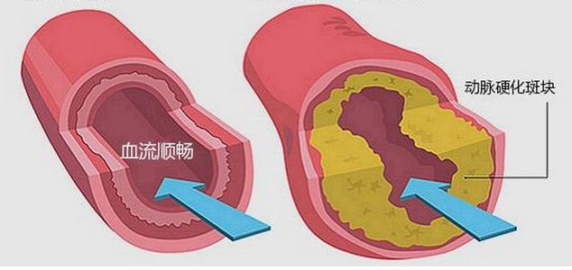 动脉硬化可以吃三七粉吗？