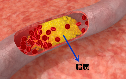 三七粉治动脉硬化怎么吃