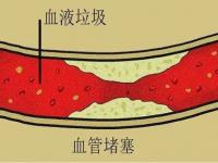 三七粉打通血管堵塞怎