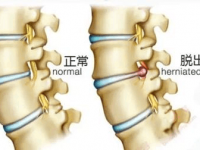 三七能治腰椎间盘突出的用法及秘方