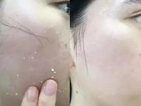 三七粉敷面膜后脸发黑是什么原因