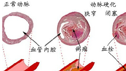 三七粉治疗动脉硬化吗