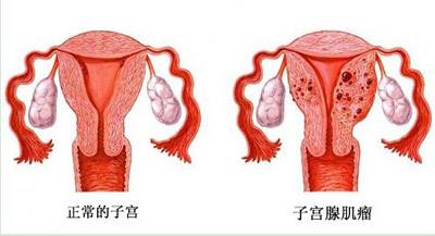 子宫肌瘤能吃三七粉吗？