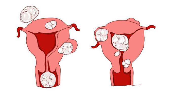 子宫肌瘤能吃三七粉吗？