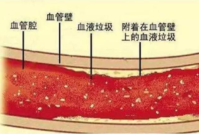 三七花对血脂稠的作用